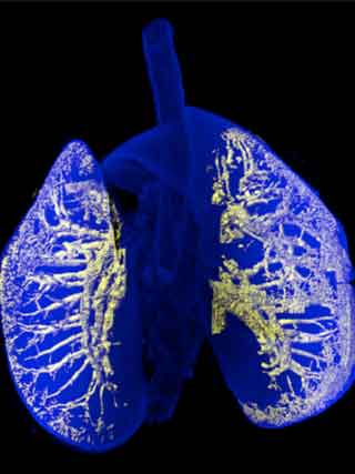 lung bronchi